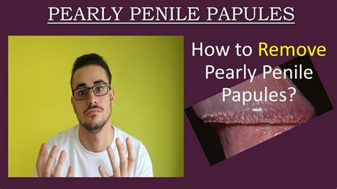 papule perlee penis|Pearly Penile Papules: White Spots on Penis